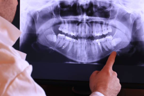 Best Knocked-Out Tooth (Avulsed Tooth) Treatment in Prosser, WA