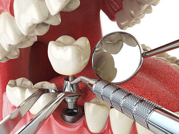 Best Lost Filling or Crown Replacement in Prosser, WA